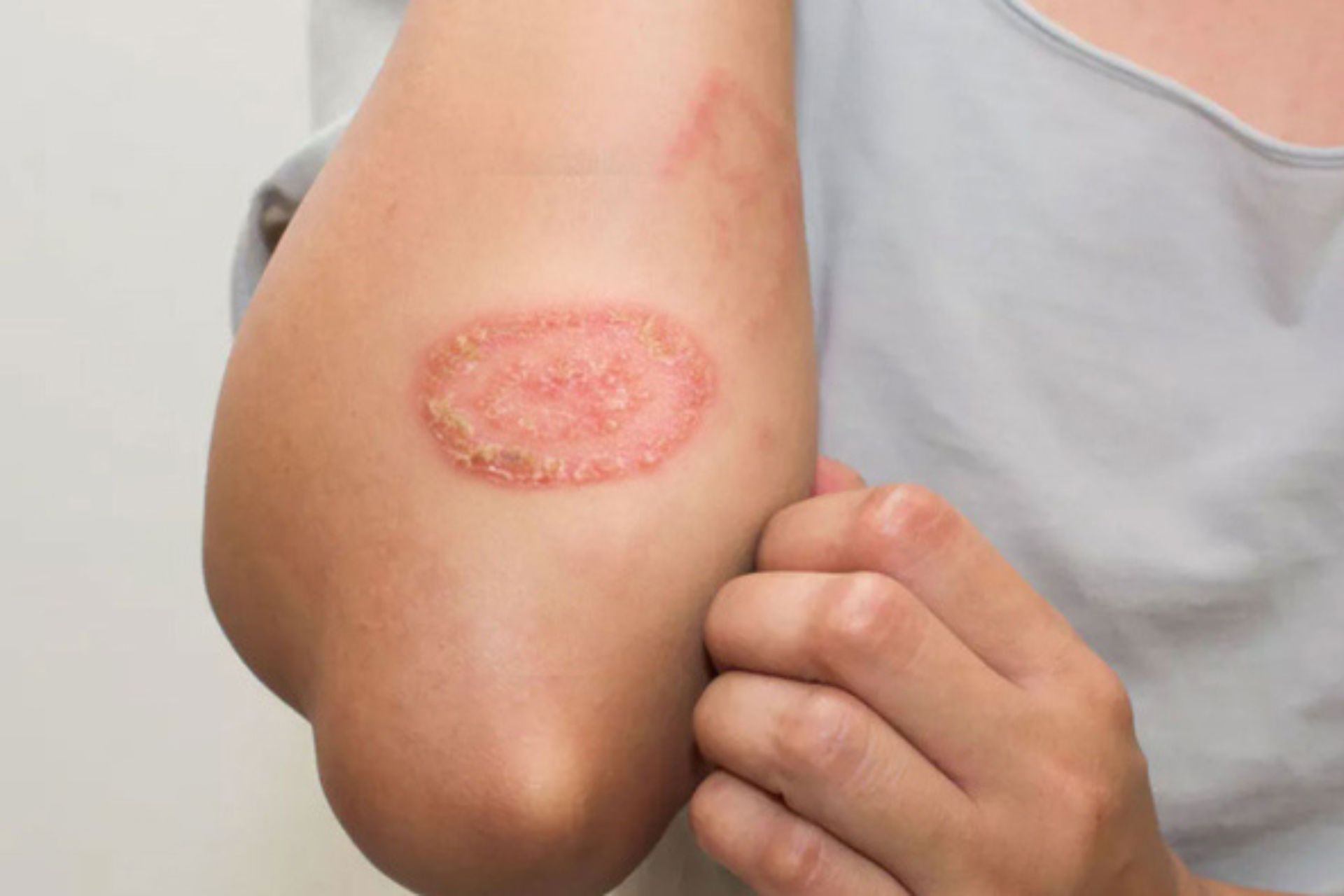 পুরাতন দাদ এর চিকিৎসা